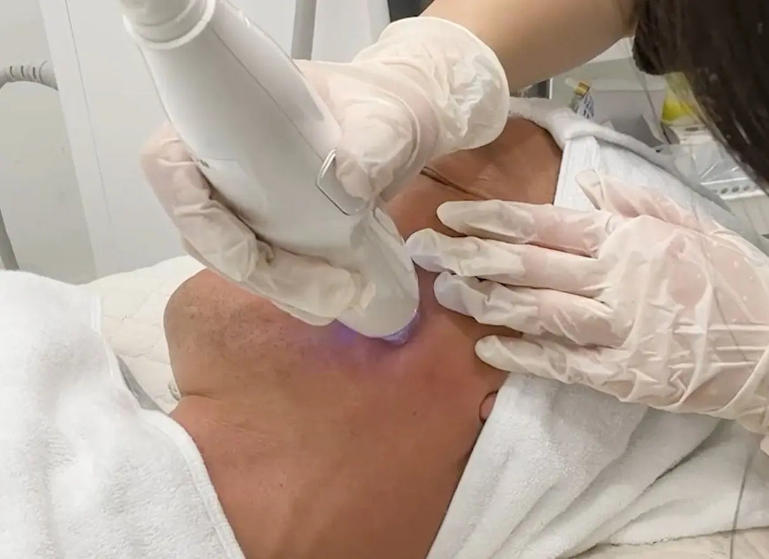 RF-Microneedling-Before-and-After Pure Tone Aesthetics