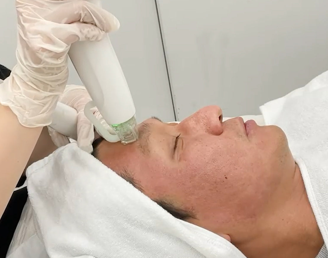 RF Microneedling