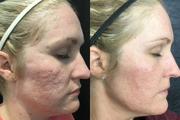 RF Microneedling Before and After | Results, Recovery & What to Expect