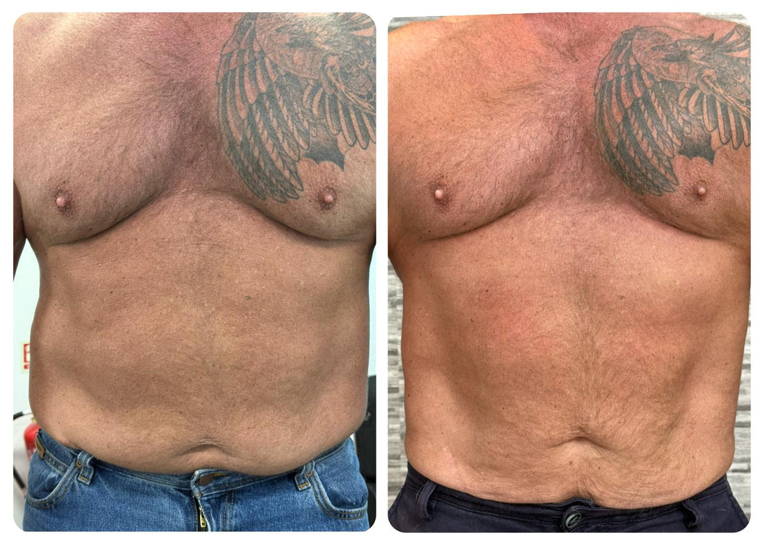 EMS Body Sculpting vs RF Body Contouring