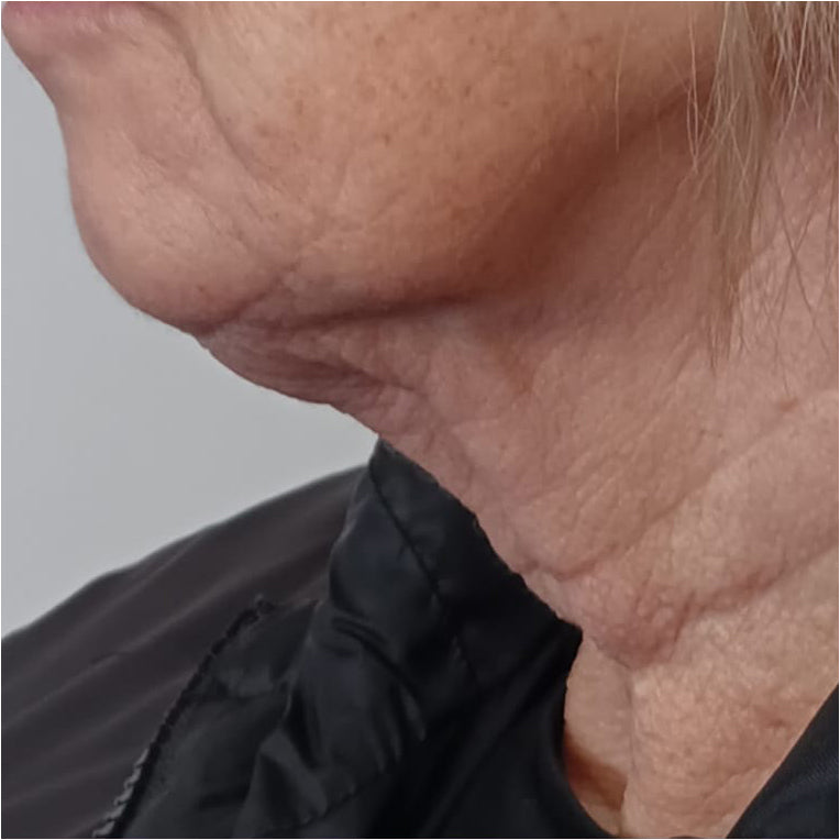 HIFU Treatment Before and After