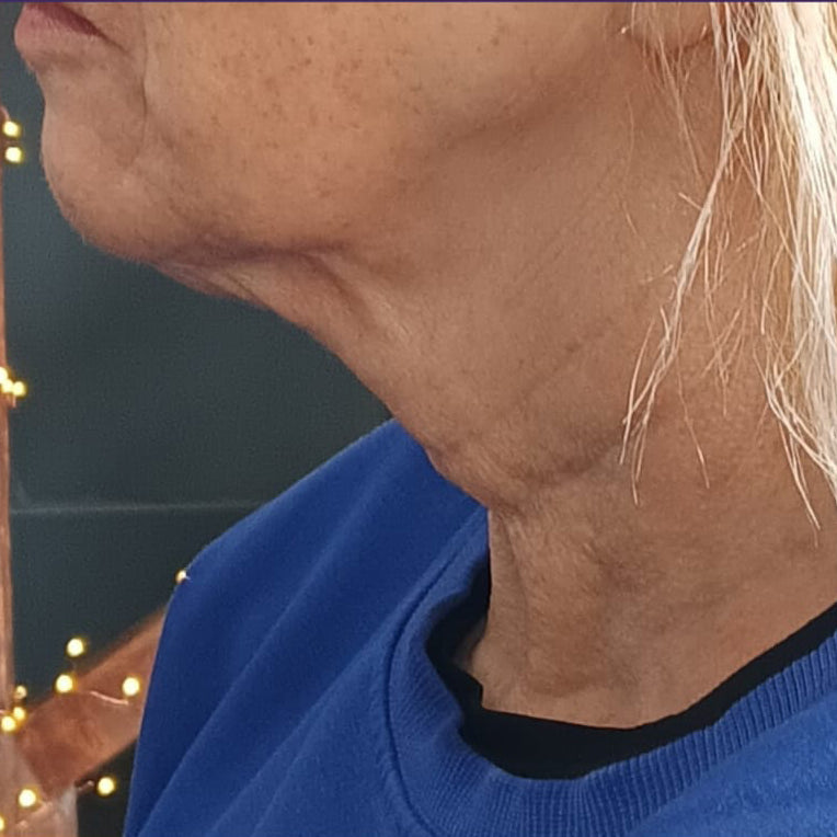 HIFU Treatment Before and After
