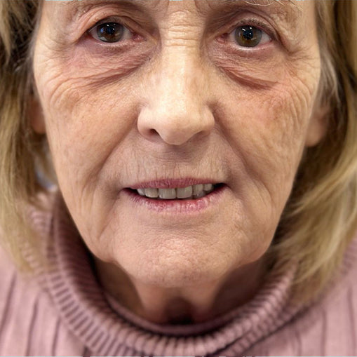 HIFU Treatment Before and After