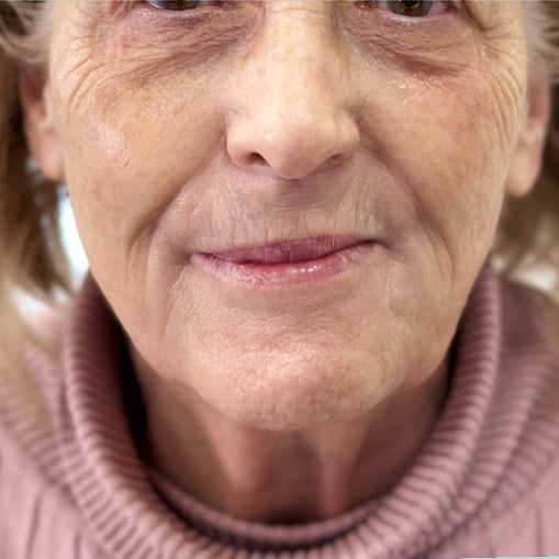 HIFU Treatment Before and After