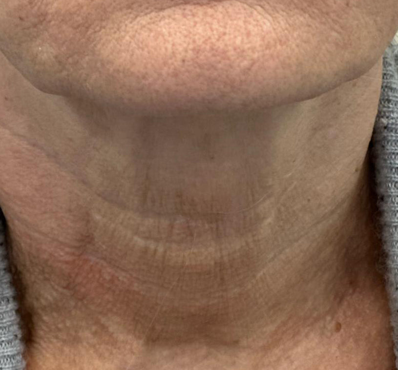 HIFU Treatment Before and After