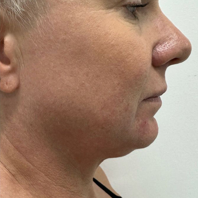 HIFU Treatment Before and After