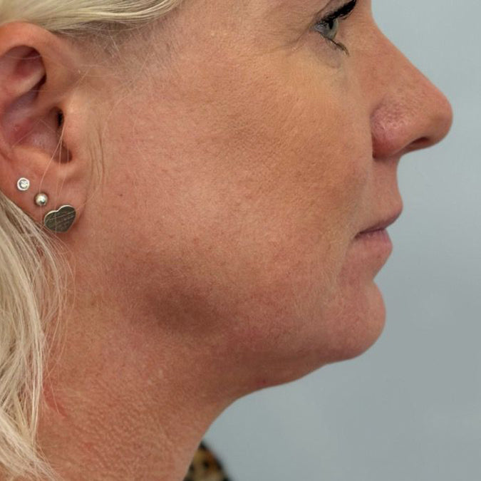 HIFU Treatment Before and After