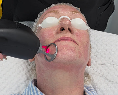 Patient receiving a professional Thulium Laser Pro™ 1927nm fractional laser skin rejuvenation treatment
